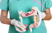 Để ung thư đại trực tràng không là án tử, cơ quan y tế dự phòng hàng đầu của Mỹ khuyến nghị người từ 45 tuổi nên tầm soát bệnh