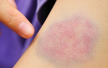 Bầm tím tay, chảy máu tự nhiên: Coi chừng căn bệnh nguy hiểm, ở viện nhiều hơn ở nhà