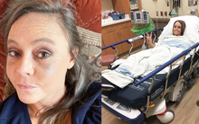 Người phụ nữ này tưởng mình bị sưng mắt do dị ứng nhưng hóa ra đó lại là triệu chứng của bệnh về mắt có liên quan tuyến giáp