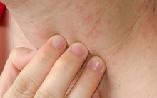 Trong người có 2 chứng "ngứa ngáy", đừng nghĩ chỉ là dị ứng mà còn có thể là dấu hiệu cảnh báo bệnh gan