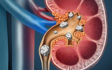 Sỏi thận – nhỏ mà... "có võ": Dấu hiệu cảnh báo sỏi đang lẩn trốn trong cơ thể mà bạn không biết