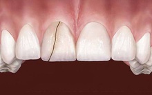 6 dấu hiệu điển hình cảnh báo nguy cơ lão hóa răng sớm mà nhiều người chẳng ngờ đến