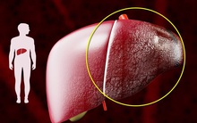 Đừng đùa với xơ gan: Ngoài rượu, còn 5 "thủ phạm" gây tổn thương gan không hồi phục