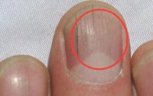 Quan sát đôi tay, nếu thấy có 3 tín hiệu xấu thì nên chú ý sức khỏe vì nguy cơ mắc bệnh về gan rất cao