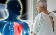 Đàn ông nên tầm soát ung thư gì: Theo tư vấn của chuyên gia ung bướu, có 4 loại ai cũng cần biết để tự bảo vệ sức khỏe