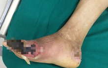 Người bệnh tiểu đường còn rất chủ quan: Chuyên gia chỉ rõ 3 biến chứng nguy hiểm nhất cần điều trị cấp cứu