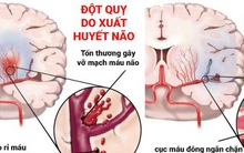 Giám đốc BV Đột quỵ: 80% trường hợp nhồi máu não có dấu hiệu này, biết sớm có thể cứu bạn khỏi đột quỵ