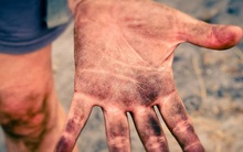 Bệnh hiếm gặp khiến con người không có dấu vân tay