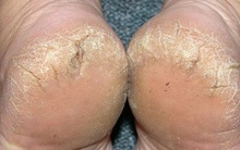 Luôn cảm thấy gót chân bị khô và nứt nẻ: 4 "thủ phạm" là nguyên nhân gây ra vấn đề này nhưng nhiều người không biết