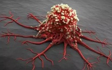 Có 4 thay đổi nhỏ trên cơ thể, hãy coi chừng vì có thể bệnh ung thư đang âm thầm tìm đến bạn