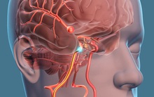 Phó Giám đốc BV Việt Đức: 3-5% dân số bị phình mạch não nhưng không phải ai cũng cần điều trị, duy trì lối sống lành mạnh rất quan trọng để tự "cứu mình"