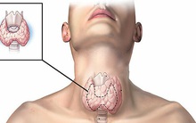 Sau 25 năm ăn muối iốt, bệnh tuyến giáp bùng phát tại TQ: Sai lầm lớn rất nhiều người mắc