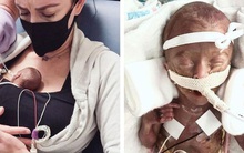Chị song sinh đã qua đời, bé gái sinh non siêu nhỏ chỉ có 10% cơ hội sống sót đang làm nên kỳ tích khiến nhiều người xúc động