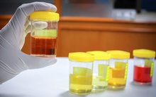 Khi gan kém sẽ có "2 vàng, 1 hôi" xuất hiện rõ trên cơ thể bạn, cần đặc biệt chú ý