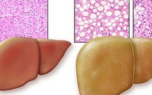 Người dưới 45 tuổi bệnh gan nhiễm mỡ đang tăng: Đừng bỏ qua bí kíp "đĩa ăn chia 4 phần"!