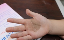 Nhiều cha mẹ tại TP.HCM đưa con đi cầu cứu bác sĩ vì bàn tay, bàn chân xuất hiện các tổn thương lạ