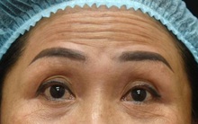 Từ vụ ngộ độc botulinum trong Pate Minh Chay: Bác sĩ tiết lộ loại độc tố này cũng được ứng dụng trong mỹ phẩm và chăm sóc sắc đẹp