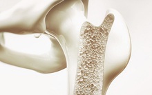 BS tiết lộ công thức tự đánh giá nguy cơ loãng xương: 3 nhóm người nên kiểm tra ngay