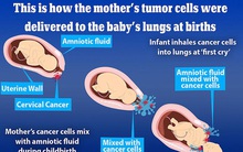 Sốc: 2 trẻ sơ sinh Nhật Bản hít phải tế bào ung thư từ mẹ