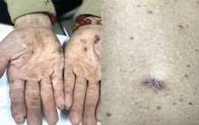 Có hay không việc mắc ung thư do nước sinh hoạt? BS cảnh báo những nơi có nguy cơ