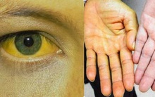Bác sĩ nhắc nhở: Trong cơ thể xuất hiện "2 vàng, 2 đỏ", nếu bỏ qua cẩn thận gan hỏng