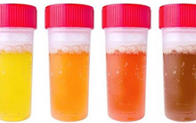 Cách đếm số lần đi tiểu, màu nước tiểu đoán tình trạng sức khoẻ