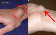 Nếu 5 bộ phận trên cơ thể đột nhiên "nổi cục" bất thường, bạn nên cẩn thận với một vài vấn đề sức khỏe, bao gồm cả ung thư