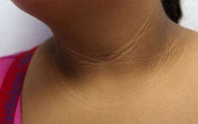 3 thay đổi trên cổ có thể là dấu hiệu sớm của bệnh ung thư mà bạn không nên chủ quan bỏ qua