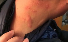 "3 ngứa" trên cơ thể cảnh báo tế bào ung thư gan đang manh nha xuất hiện