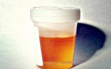 3 vấn đề khi đi vệ sinh vào buổi sáng là dấu hiệu cho thấy tế bào ung thư đang hoạt động