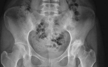 Cô gái bị đau lưng không ngủ được, khám thấy xương "thủng như tổ ong", tất cả là do 1 loại nước nhiều người yêu thích