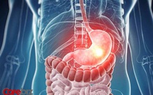 Lợi bất cập hại: 7 món ăn người Việt ưa chuộng nhưng lại là TỘI ĐỒ nghiền nát dạ dày nếu ăn liên tục