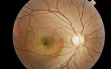 BS nhãn khoa: Người trẻ sử dụng điện thoại, máy tính nhiều có thể mắc bệnh mắt vĩnh viễn