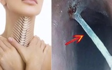 Thủng dạ dày, thực quản vì hóc xương chữa mẹo: Bác sĩ mách 2 việc cần làm khi hóc xương