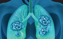 Sau 40 năm nghiên cứu, các nhà khoa học đã bắn hạ được 'Ngôi sao tử thần' của bệnh ung thư