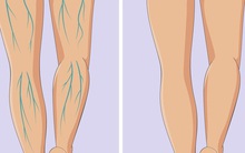 Có cục máu đông trong cơ thể: bạn có thể phán đoán thông qua 3 hiện tượng bất thường ở bàn chân