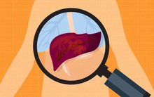 Gan kém có 4 dấu hiệu rõ rành rành sau, cần gặp bác sĩ ngay: Tuyệt chiêu bảo vệ gan trước khi quá muộn