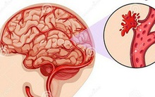 Đột quỵ đang ngày càng trẻ hóa ở Việt Nam: Bác sĩ chỉ ra thủ phạm vô cùng 'quen mặt'