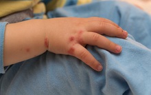 Cả nước ghi nhận hơn 18.400 ca mắc tay chân miệng, 4 trường hợp tử vong: Bệnh tay chân miệng có lây không?