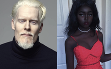 8 người sinh ra với màu da lạ kỳ chẳng giống ai nhưng lại đẹp đến mê hoặc: Từ "búp bê Barbie đen" đến "cô gái bạch tạng đẹp nhất thế giới"