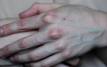 Có 4 dấu hiệu này xuất hiện trên bàn tay, cảnh báo mạch máu bị tắc nghẽn