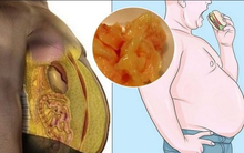 Tại sao ngày càng có nhiều người béo phì: Trong 7 lý do chính này, bạn có bao nhiêu?