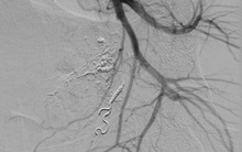 90 phút "đấu trí" với tử thần: Lần đầu tiên tại Việt Nam can thiệp thành công ca tổn thương động mạch trực tràng hiếm gặp