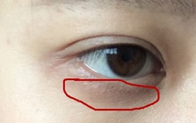 3 bộ phận trên khuôn mặt chuyển sang màu thâm đen cho thấy sức khỏe của bạn đang có vấn đề, cần đi kiểm tra ngay