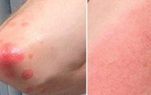 4 tác dụng phụ sau khi tiêm vaccine COVID-19 trên da hay gặp nhất: Có đáng lo ngại không?