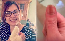 Sơn màu đỏ để che đi móng tay xấu xí, người phụ nữ không ngờ đó là dấu hiệu ung thư: Nếu có 3 biểu hiện này ở tay, cần đi khám ngay