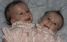 Bị chẩn đoán khó sống sót, cặp chị em sinh đôi dính liền chỉ có 2 chân khiến thế giới kinh ngạc với cuộc sống và diện mạo sau hơn 30 năm