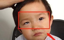 Bé trai 5 tuổi mắt thâm đen, con ngươi 1 bên mắt "biến mất", bị lác nghiêm trọng bởi thói quen "dễ dãi" của nhiều bố mẹ trẻ