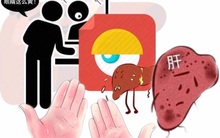 Da chuyển vàng, mặt chuyển đen và bộ phận này chuyển đỏ là dấu hiệu của bệnh gan: Kiểm tra ngay để không bị ung thư "gõ cửa"