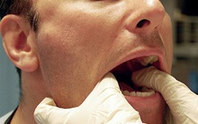 Chuyên gia chỉ cách phân biệt: Ung thư vòm họng với viêm họng, viêm amidan